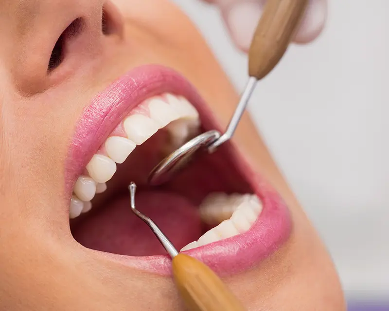 Soin d’endodontie réalisé par un dentiste à Samatan